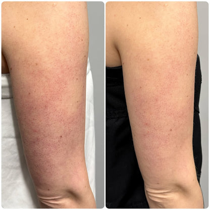 Lymfaattinen Vartaloharja